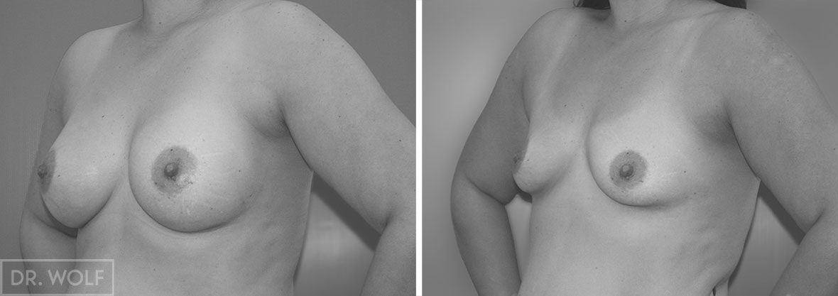 ניתוח הגדלת חזה לפני ואחרי - מקרה 1 זווית צד