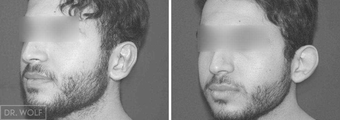 תוצאות הצמדת אוזניים לפני ואחרי