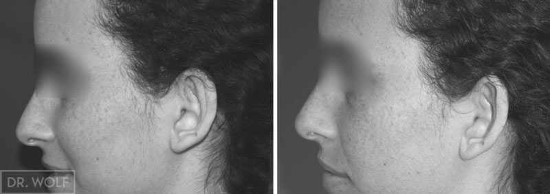 ניתוח הצמדת אוזניים - תוצאות