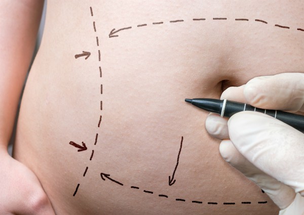 ניתוח מתיחת בטן אחרי הריון