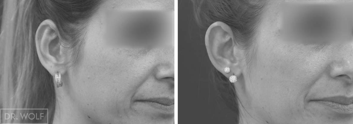 ניתוח הצמד אוזניים בולטות, מקרה 3, מבט מהצד