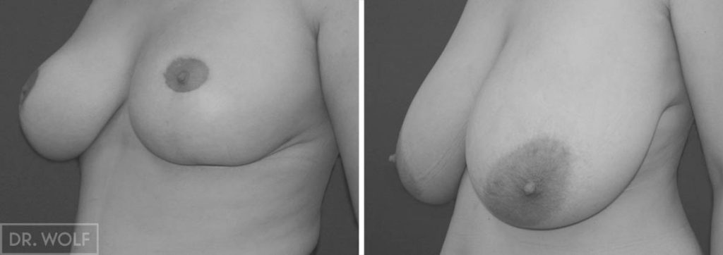 ניתוח הקטנת חזה, לפני ואחרי, מקרה 2 , מבט מהצד