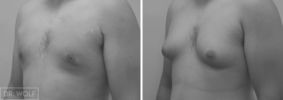 ניתוח גינקומסטיה תמונות לפני ואחרי