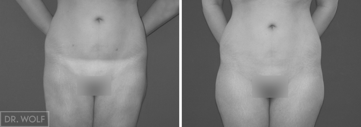 ניתוח שאיבת שומן תמונות לפני ואחרי