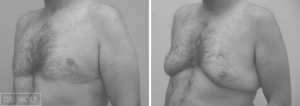 ניתוח הקטנת חזה לגבר לפני ואחרי - צד שמאל