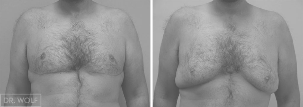 ניתוח הקטנת חזה לגבר לפני ואחרי - חזית