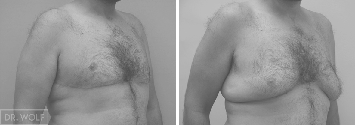 ניתוח הקטנת חזה לגבר לפני ואחרי - צד ימין