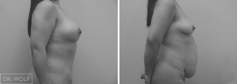 תוצאות ניתוח mommy makeover - תמונות לפני ואחרי