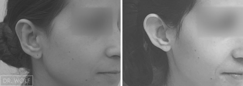 הצמדת אוזניים לפני ואחרי - צדימין