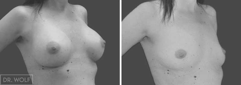 ניתוח הגדלת שדיים מקרה 19 שמאל